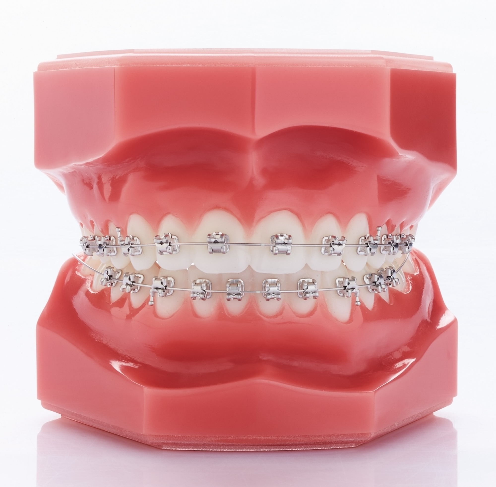 Dr Wagner, Kieferorthopädie Wiesbaden, lose Zahnspange, selbstligierende Brackets