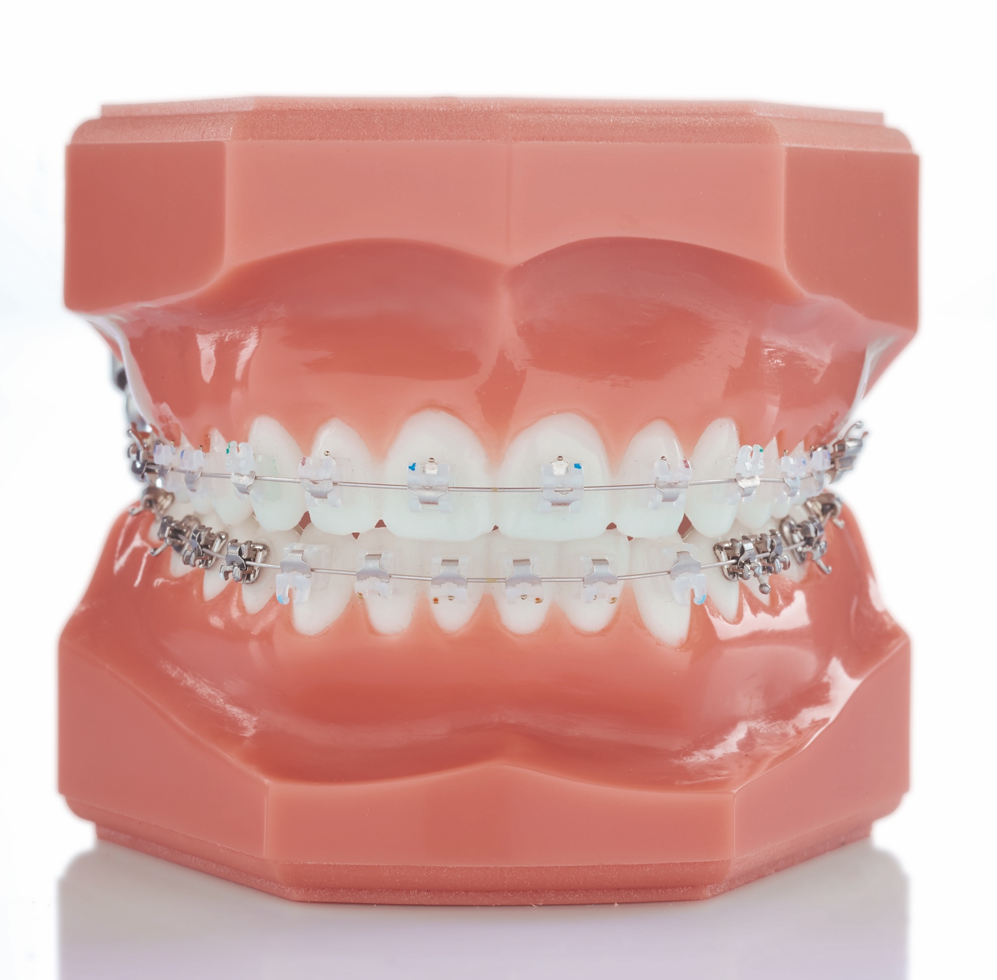 Dr Wagner, Kieferorthopädie Wiesbaden, lose Zahnspange, selbstligierende Brackets